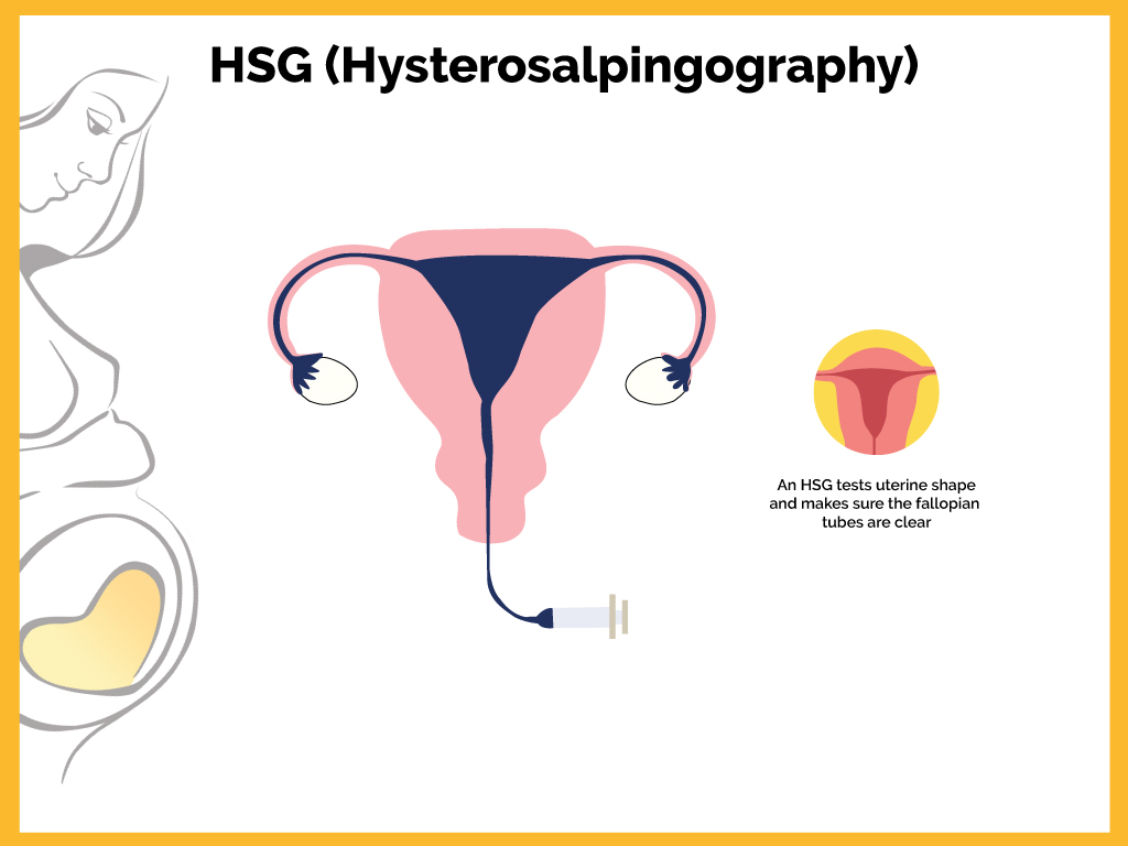 Dream Flower IVF Centre|Best Infertility treatment centre in South India - Hysterosalpingography (HSG)