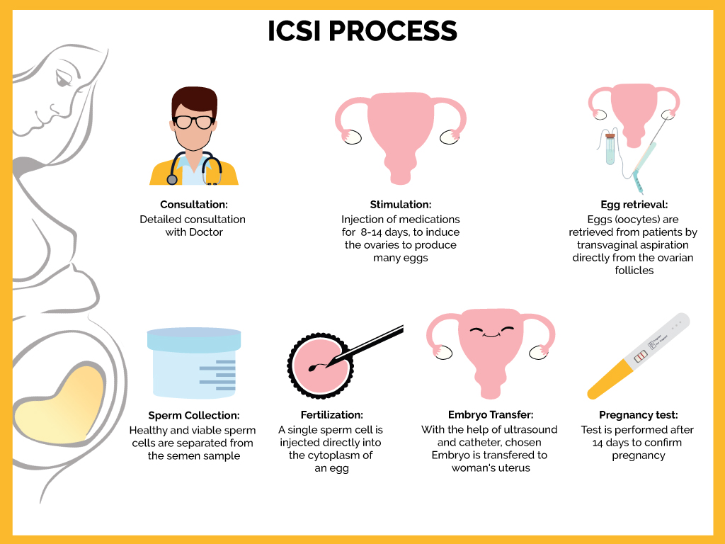 Dream Flower IVF Centre|Best Infertility treatment centre in South India - Intracytoplasmic Sperm Injection: ICSI