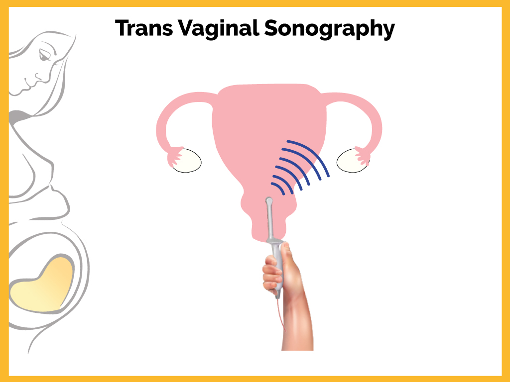 Dream Flower IVF Centre|Best Infertility treatment centre in South India - Trans Vaginal Sonography