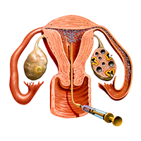 Dream Flower IVF Centre|Best Infertility treatment centre in South India - Ovulation Induction